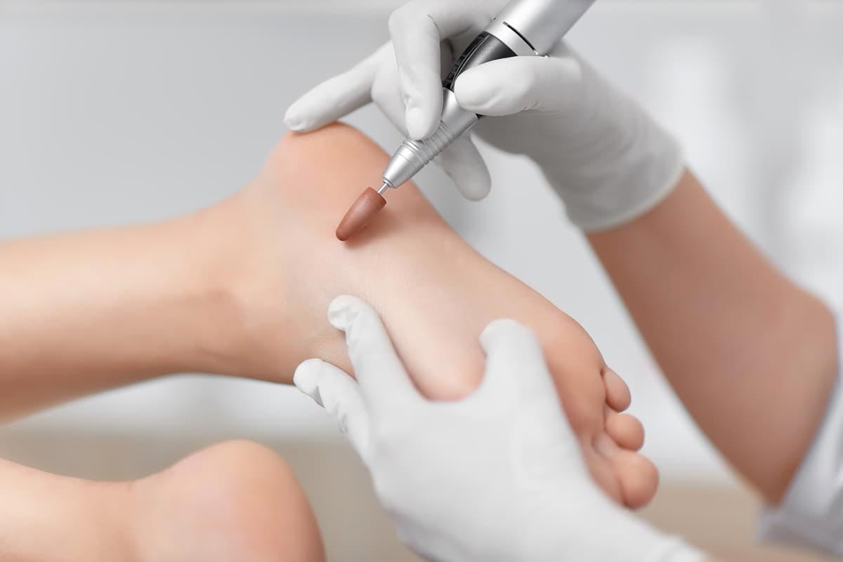 Tratamiento de durezas en los pies en Vigo