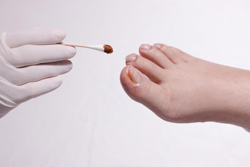 Tratamiento de uñas encarnadas en Vigo